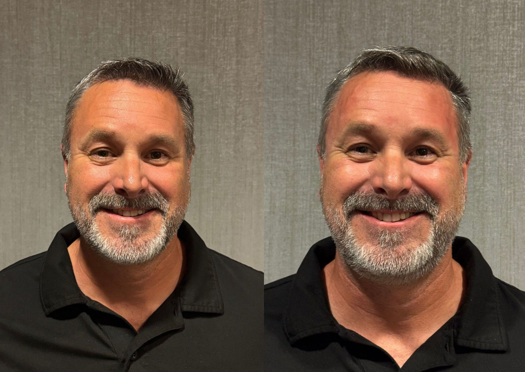 Temple Filler - Before & After